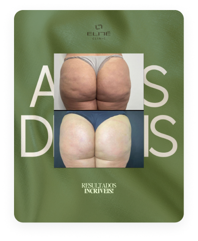 Resultado antes e depois 4